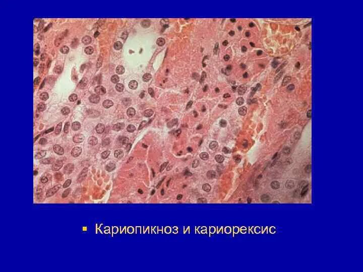 Кариопикноз это. Кариорексис кариолизис. Кариопикноз кариорексис кариолизис некроз. Кариопикноз гистология. Кариорексис это гистология.