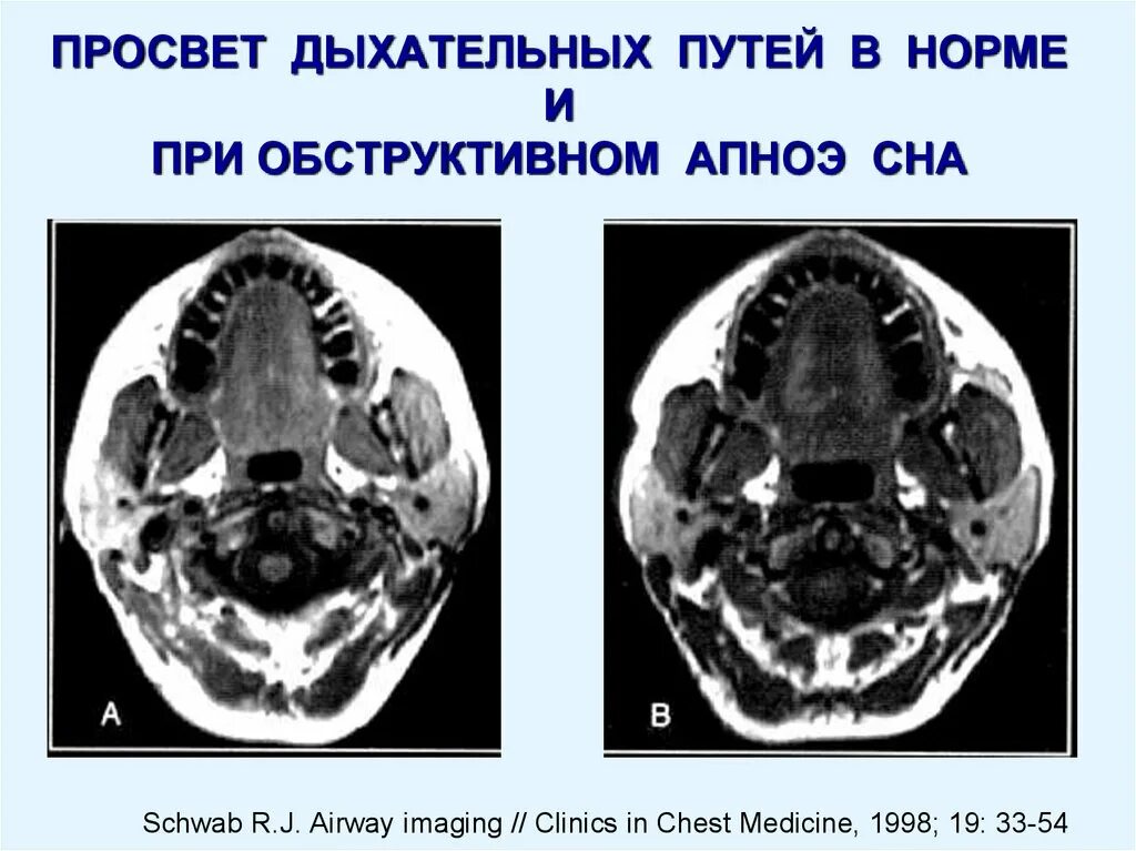 Бронхоскопия инородное тело. Кт дыхательной системы. Компьютерная томография легких. Оценка дыхательных путей на кт. Кт дыхательных путей.