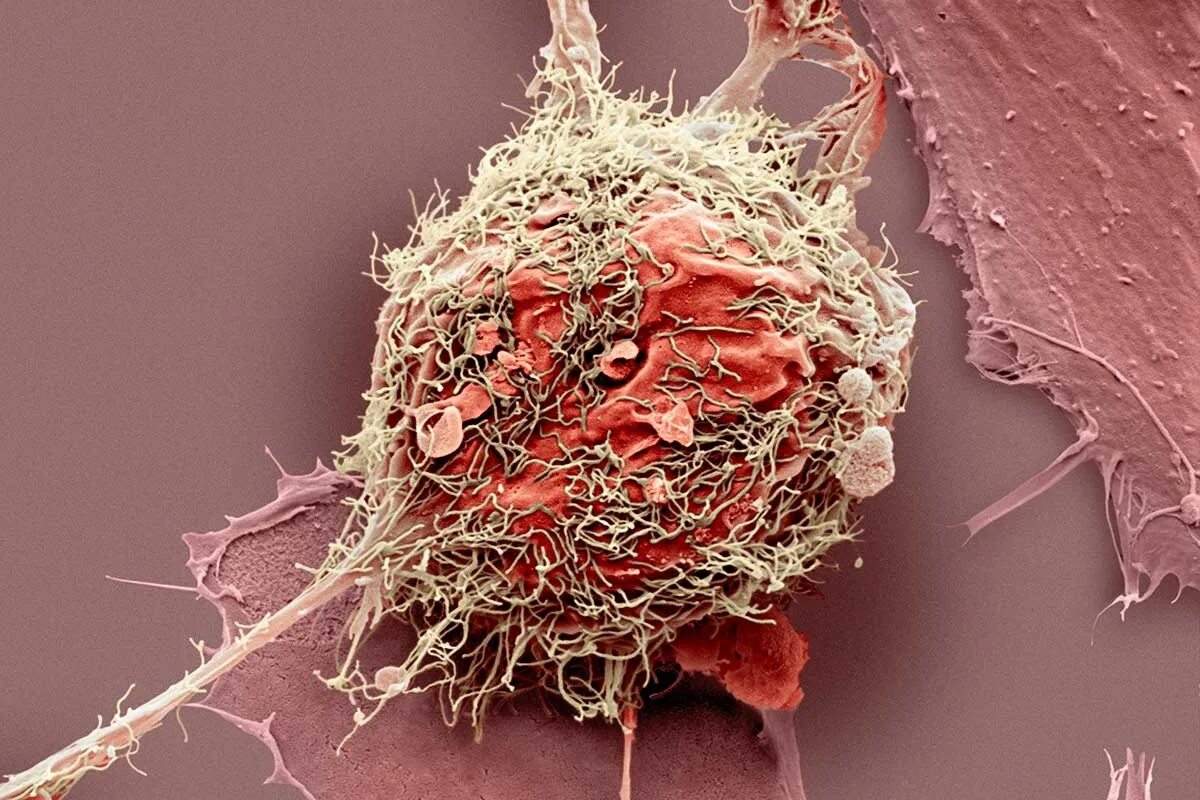 Cancer edition