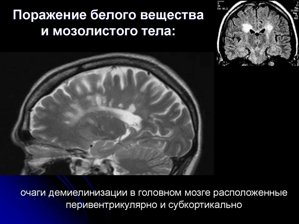 Поражение белого вещества мозга. Поражение мозолистого тела при рассеянном склерозе мрт. Очаги рассеянного склероза на мрт. Очаги демиелинизации на кт. Очаги демиелинизации на мрт.