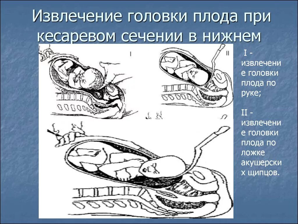 При симфизите делают кесарево. При симфизите делают кесарево