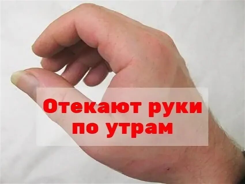 Отек пальцев рук по утрам. Руки отекли что принять. Почему отекают руки по утрам.