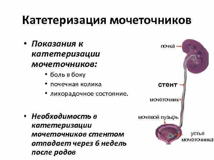 Сильные боли в мочеточнике