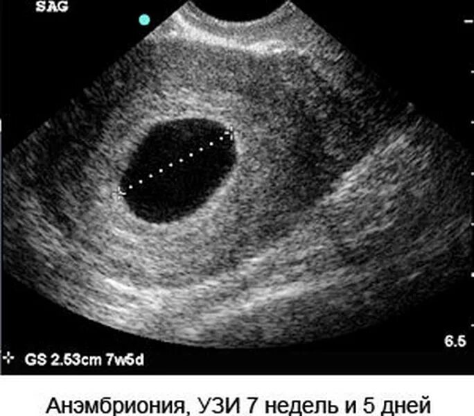 Замершая беременность причины в первом триместре. Неразвивающаяся беременность 7 недель УЗИ. Анэмбриония – пустое плодное яйцо. Анэмбриония на УЗИ 6 недель. Снимок УЗИ плодного яйца.
