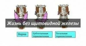 Удалили щитовидку инвалидность