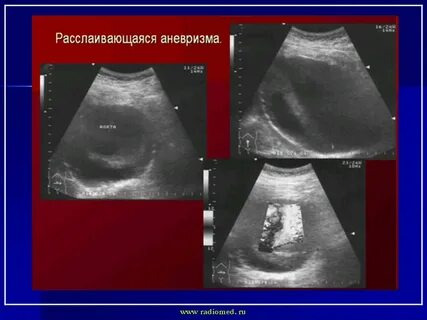 Узи аорты