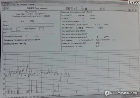 КТГ плода при схватках. Показатель схваток на КТГ. Плохое КТГ. Тонус по КТГ. Ктг на 40 неделе