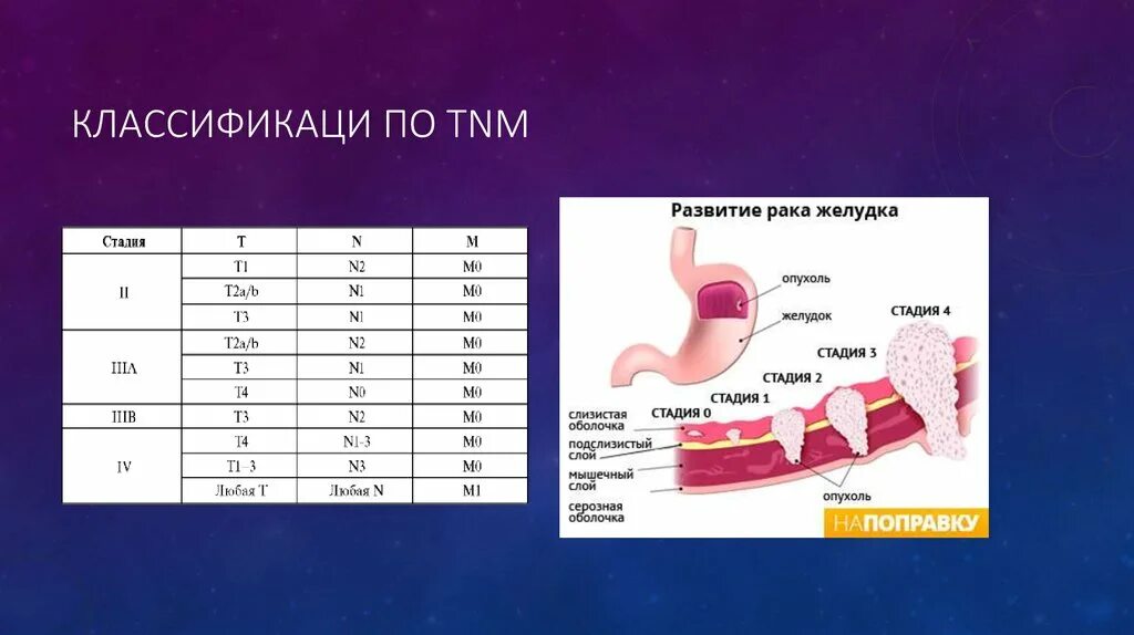 Опухоли желудка классификация. Опухоль желудка стадии. Стадии TNM. Опухоль желудка по ТНМ. Онкология желудка 4 стадия