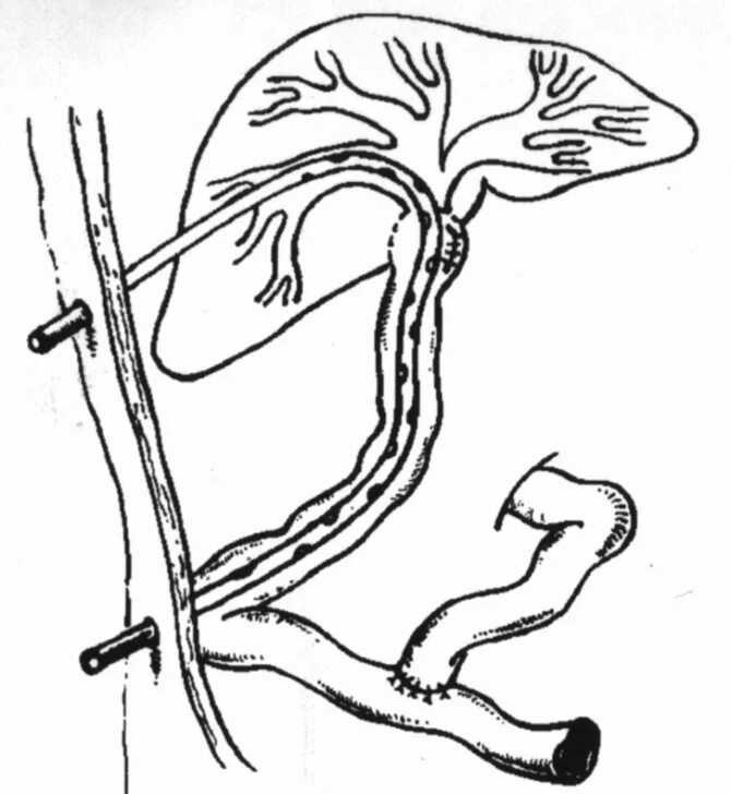 Транспеченочное дренирование. Дренирование желчных протоков. Дренирование внутрипеченочных желчных протоков. Внутреннее дренирование желчных протоков.