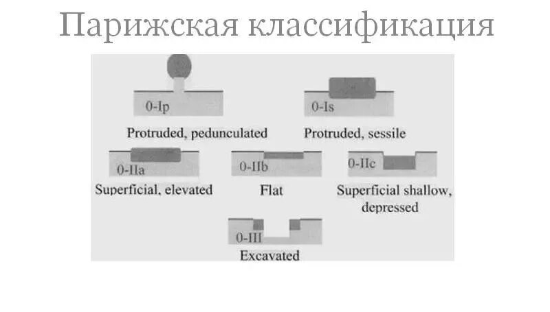 Тип 0 is. Парижская классификация. Парижская классификация опухолевых поражений. Парижская классификация опухолевых поражений ЖКТ. Парижская классификация образований.