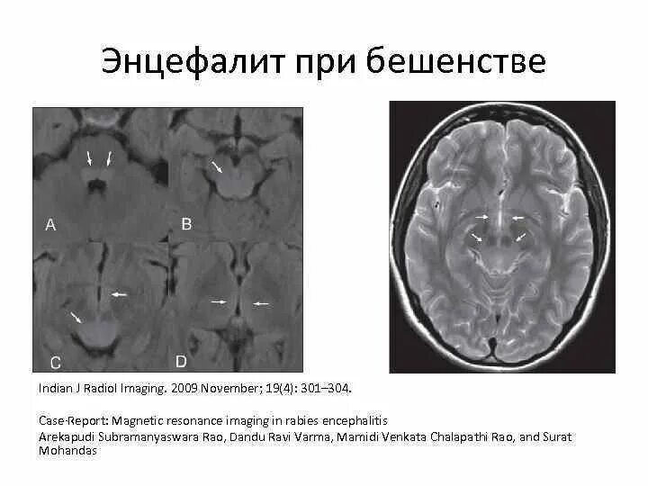 Энцефалит мозга у взрослых. Некротизирующий энцефалит мрт. Ковидный энцефалит мозга. Постинфекционный энцефалит.