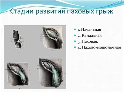 Грыжа у мужчин симптомы справа внизу живота