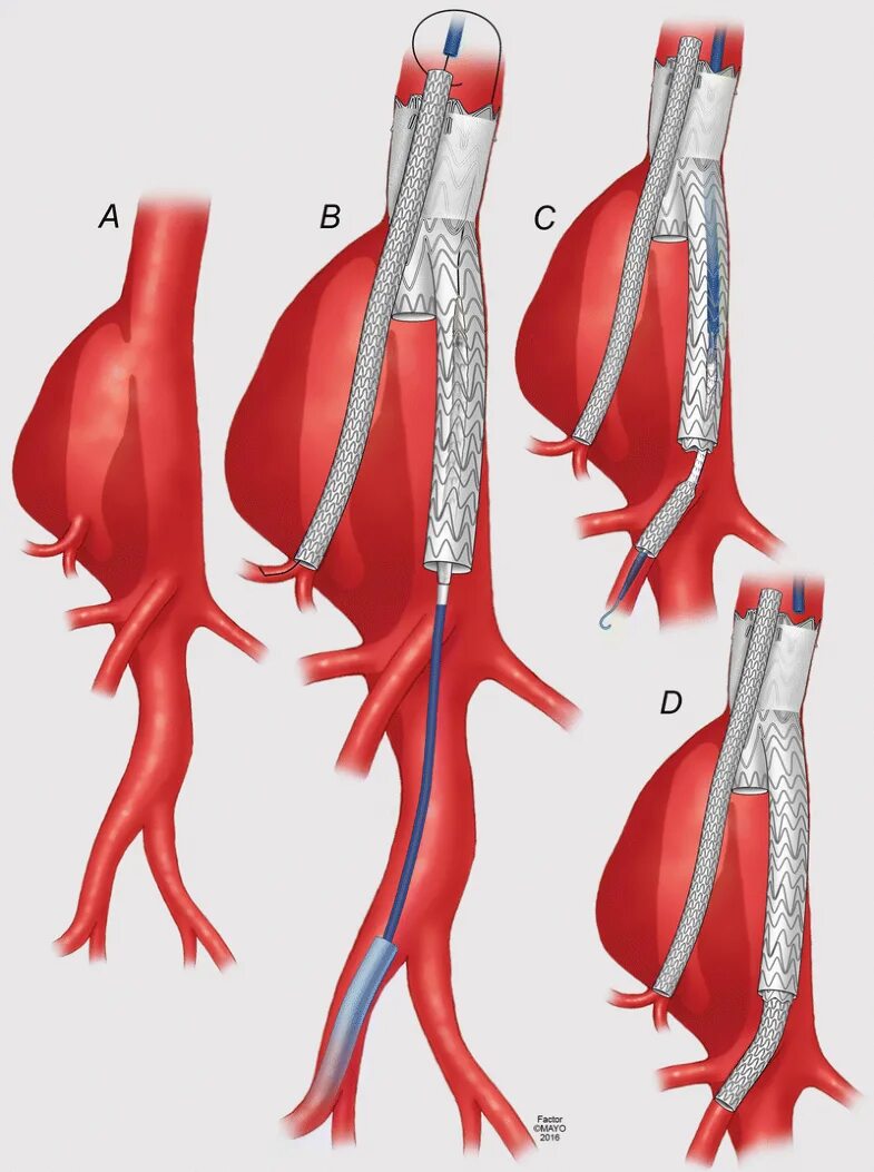 Аневризма стент. Стент графт аневризма брюшной аорты. Стент графт грудной аорты. Стент графт аорты операция.