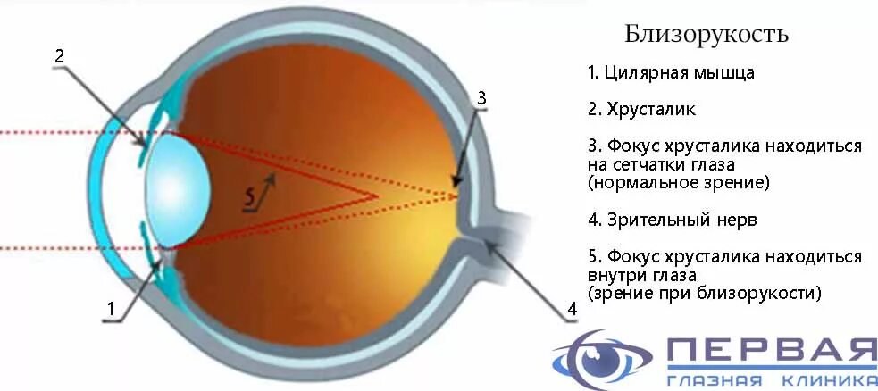 Близорукость хрусталик. Хрусталик при близорукости. Симптоматика близорукости. Причины близорукости. Перед сетчаткой расположена