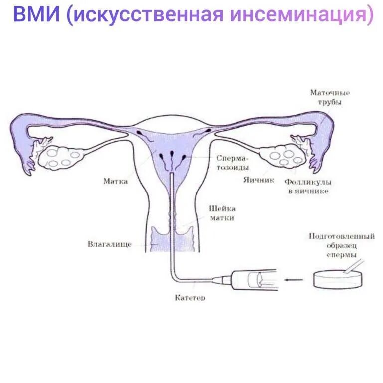 Искусственная инсеминация. Вми в гинекологии. Внутриматочная инсеминация (вми). Вми в гинекологии. Искусственное оплодотворение женщины.
