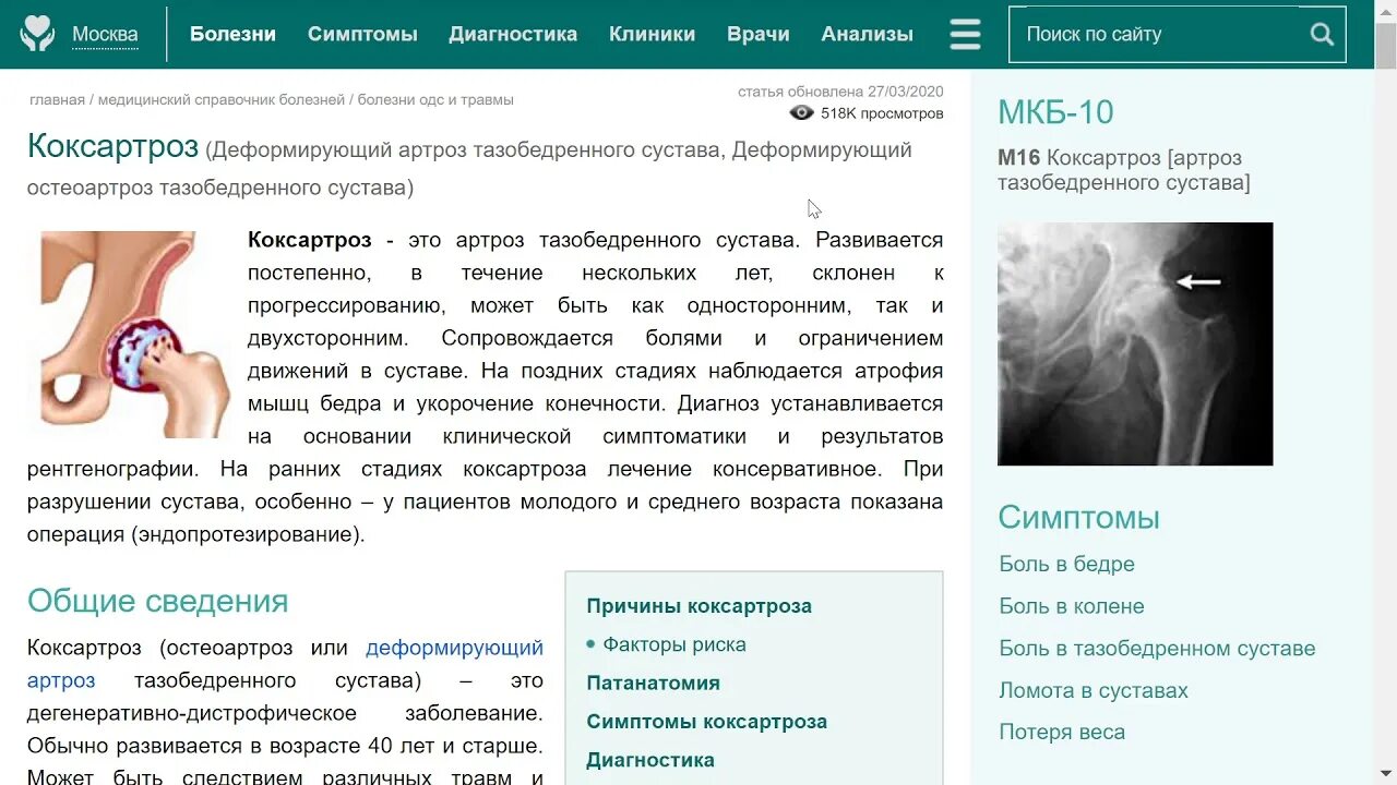 Тазобедренный сустав лечение врач. Коксартроз тазобедренного диагноз. Классификация коксартроза. Коксартроз тазобедренного сустава мкб мкб 10. Коксартроз тазобедренного сустава мкб.