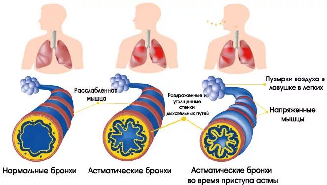 Физическая бронхиальная астма. Изменение бронхов при бронхиальной астме. обструкция дыхательных путей бронхиальная астма. период обратного развития бронхиальной астмы. легкий приступ бронхиальной астмы.