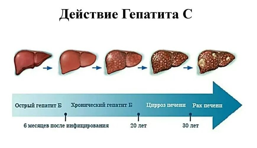 Острый и хронический гепатит. Стадии поражения печени. Острое поражение печени. Стадии вирусного гепатита