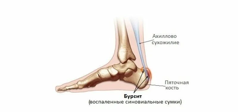 Бурсит пятки фото - ViktoriaFoto.ru
