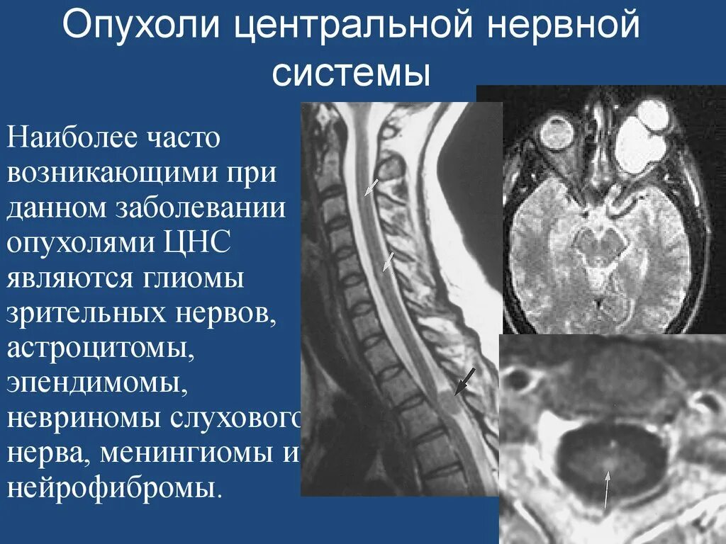 Опухоли центральной нервной. Опухолевые заболевания ЦНС. Опухоли нервной системы неврология. Опухоли мозга неврология