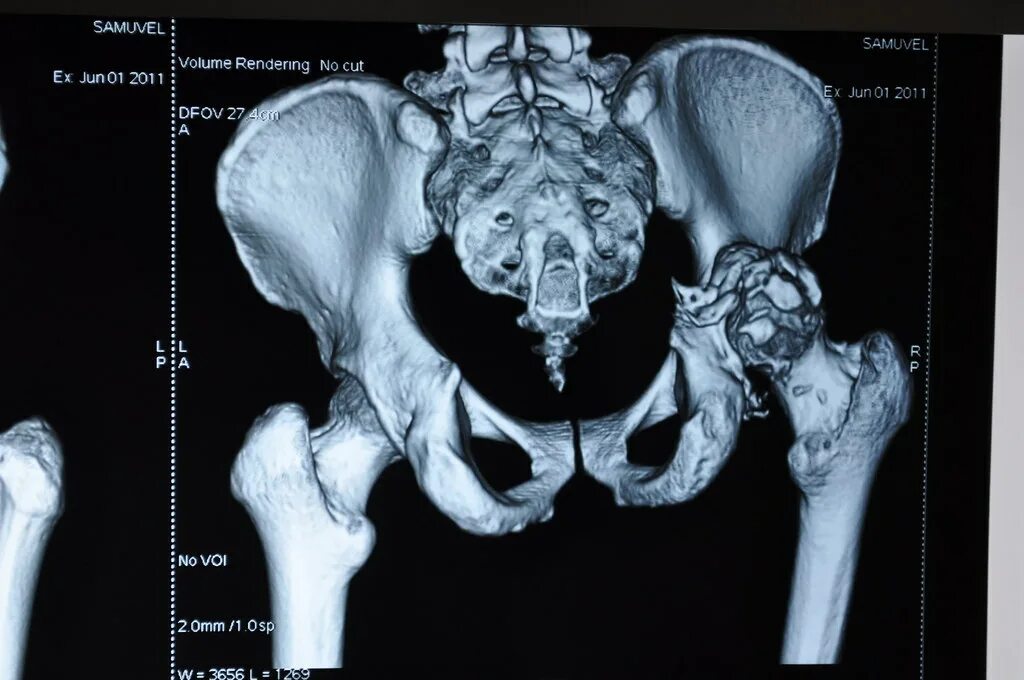Кт подвздошной кости. Перелом вертлужной впадины рентген. Перелом костей таза кт. Перелом вертлужной кости тазобедренного сустава. Перелом вертлужной впадины мрт.