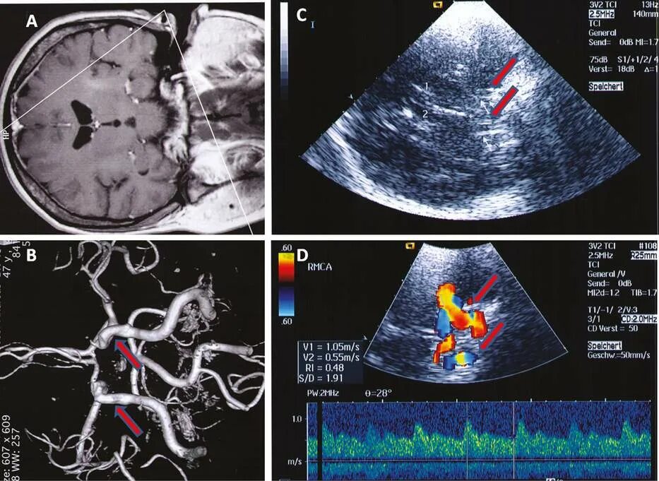 Узи артерий мозга. Транскраниальный датчик УЗИ. Транскраниальное дуплексное исследование сосудов головного мозга. Транскраниальная ультразвуковая допплерография. Допплерография сосудов головного мозга.
