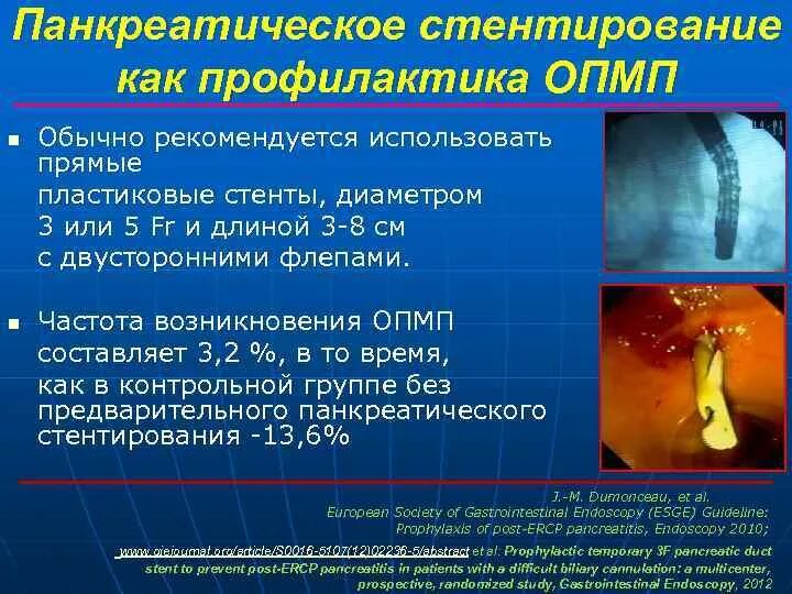 Операция при остром панкреатите. Эндоскопическое стентирование панкреатического протока. Стентирование главного панкреатического протока. Стентирование панкреатического протока операция. Эндоскопическое стентирование желчного протока.