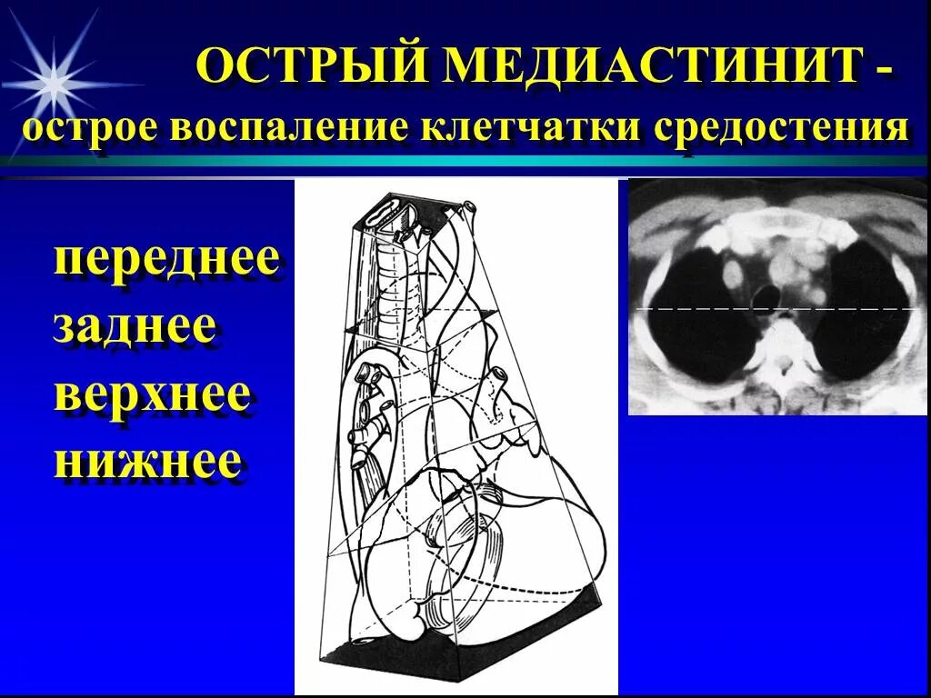 Фиброзирующий медиастинит. Медиастинит этиопатогенез. Острый Гнойный медиастинит. Медиастинит лечение