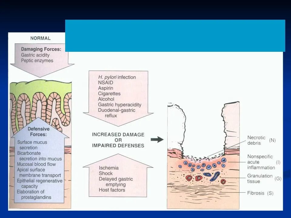 Возникновение язвы желудка. Этиология язвенной болезни 12 перстной. Язвенная болезнь желудка и 12 перстной кишки этиология. Этиология язвы желудка и 12 перстной. Патогенез язвенной болезни 12 перстной кишки.