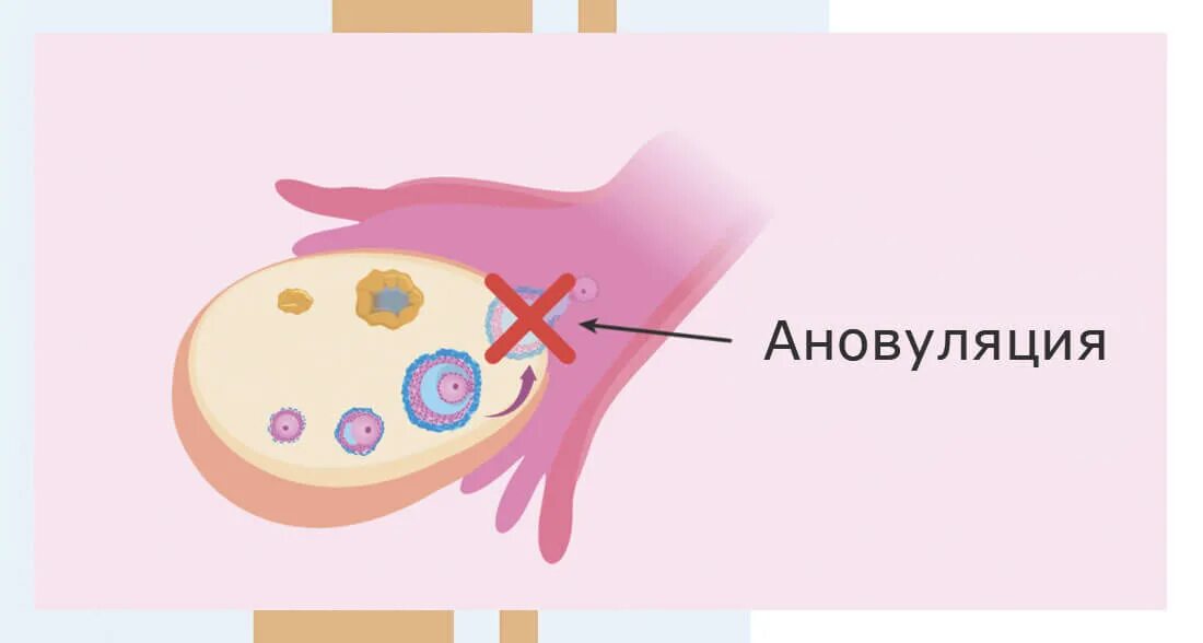 Ановуляция. Отсутствие овуляции. Признаки ановуляции. Ановуляция симптомы. Лопнула овуляция