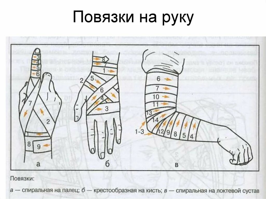 Как перевязать карту. Схема перевязки руки бинтом. Схемы наложения повязок. Схема наложения повязки на руку. Виды перевязок на руку.