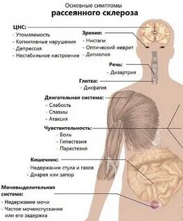 Склероз конечностей симптомы