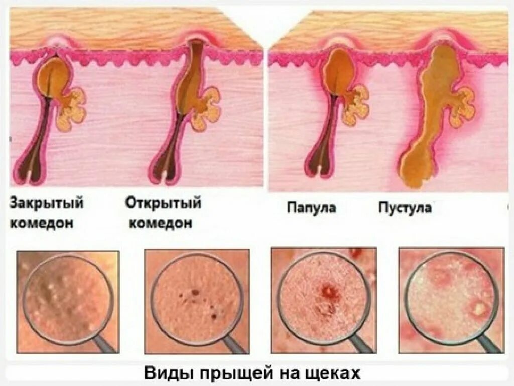 Папуло-пустулезные угри. Папулопостулезная форма акне. Пор алы