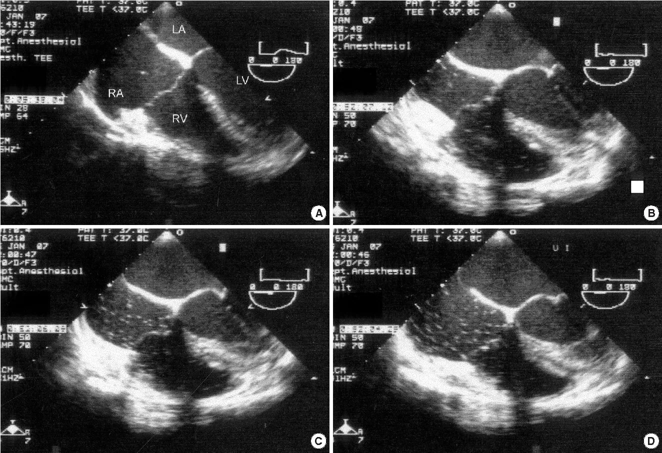 Эхокардиография сердца трансторакальная. Эхокардиография (узи сердца / эхо кг). Трансторакальная трехмерная эхокардиография. Трансторакальная эхокг. Узи сердца (эхокардиография).