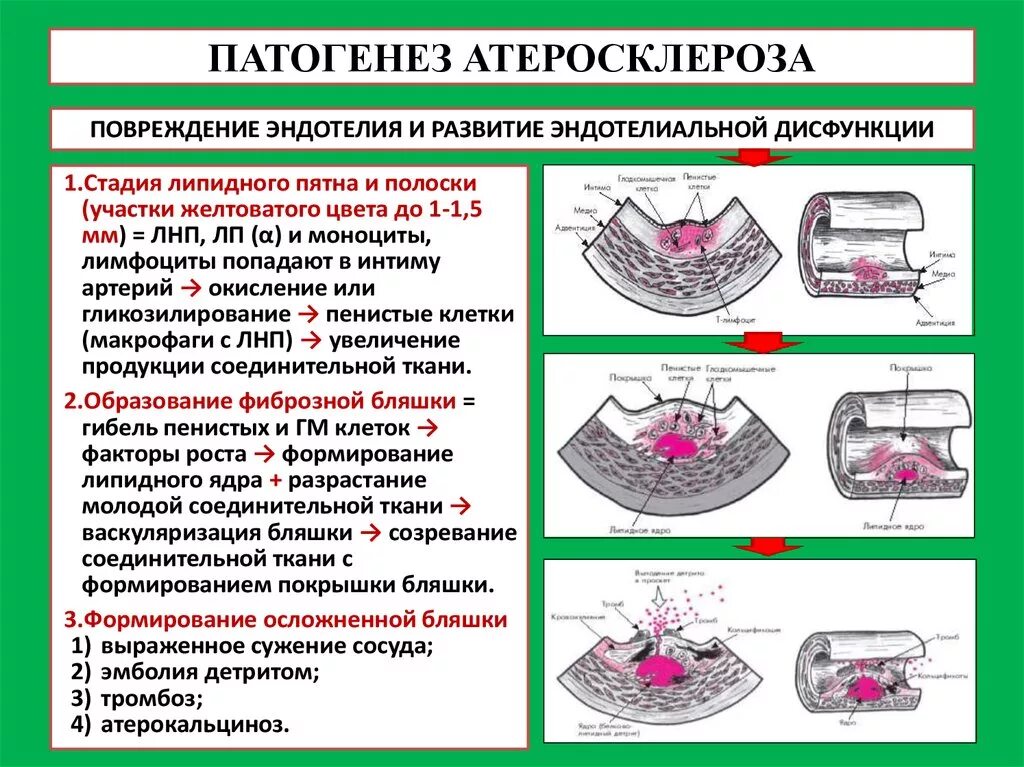 Нарушение функций 1 степени. Формирование атеросклеротической бляшки патогенез. Механизмы развития атеросклероза патфиз. Механизм формирования атеросклеротической бляшки. Стадии и механизм развития атеросклероза.