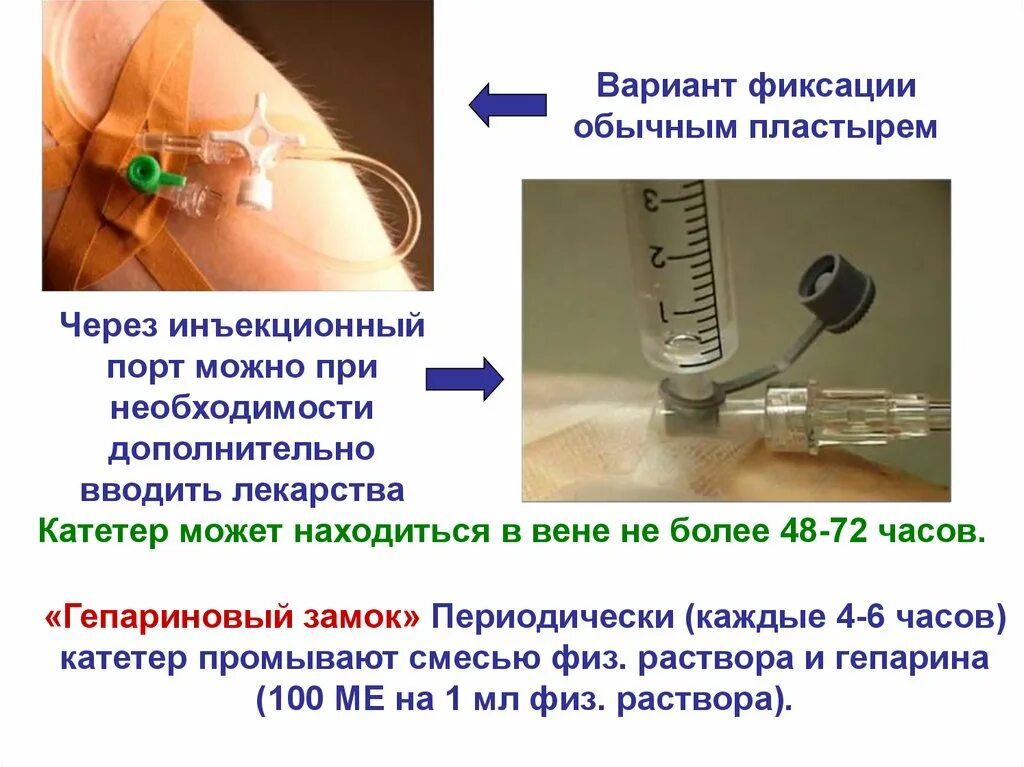 Гепариновый катетер