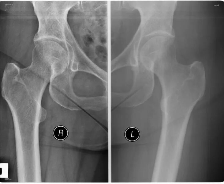 Операция тазобедренного сустава 1 степени. Деформирующий артроз (коксартроз). Деформирующий артроз тазобедренного сустава рентген. Деформирующий артроз тазобедренного сустава 1 степени. Коксартроз тазобедренного сустава 2 степени снимок.