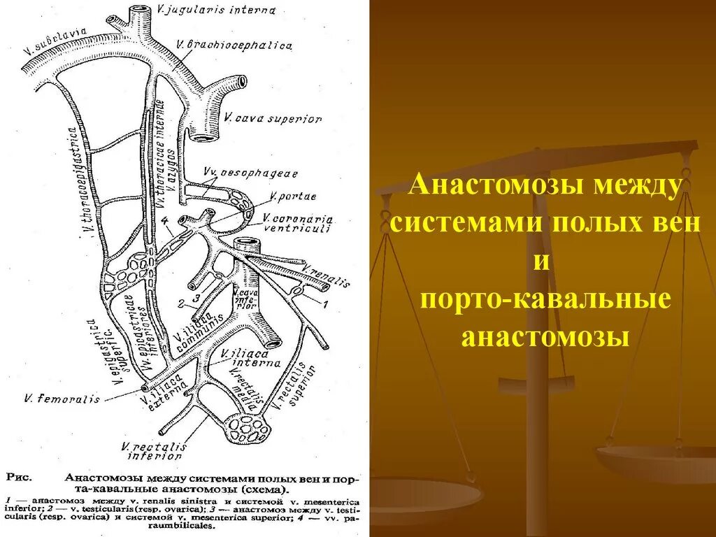 Порто портальный. Порто портальный. Порто портальный. Портальная гипертензия анастомозы. Порто портальный.