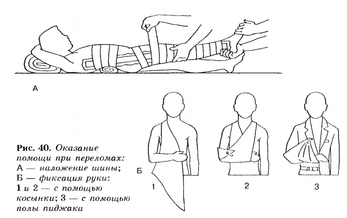 Переломы первая помощь. Оказание первой медицинской помощи при переломах костей. Оказание первой доврачебной помощи при переломе ног. Каковы принципы оказания первой помощи при переломе. Перелом и оказание первой медицинской помощи при переломе.