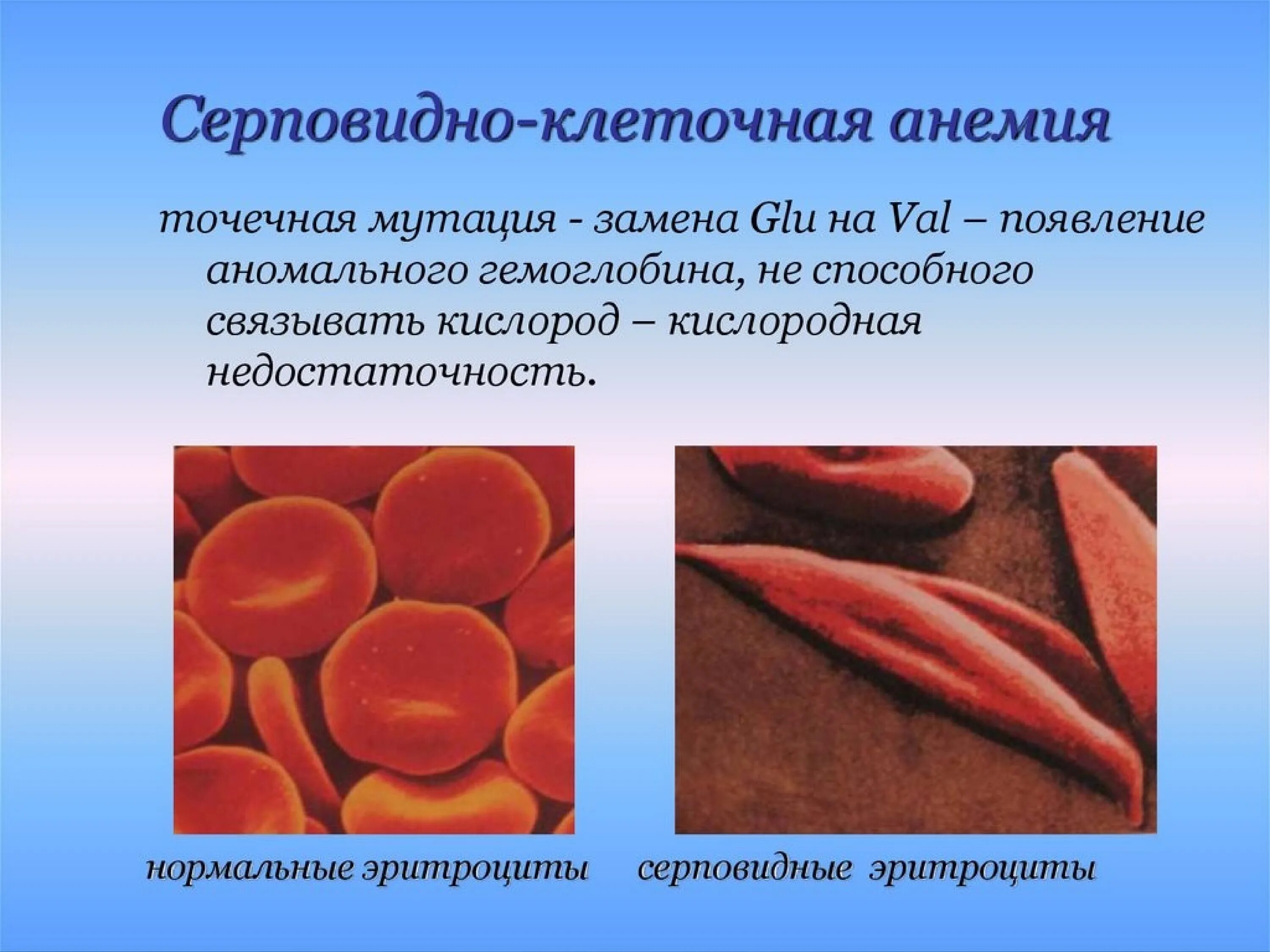 Малокровие эритроцитов. Эритроциты при серповидноклеточной анемии. Серповидноклеточная анемия генная мутация. Серповидная анемия генное заболевание. Серповидная клеточная анемия гемоглобин.