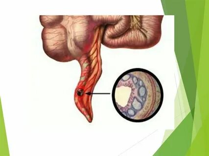 Текла қатерлі ісігінің фотосуреті