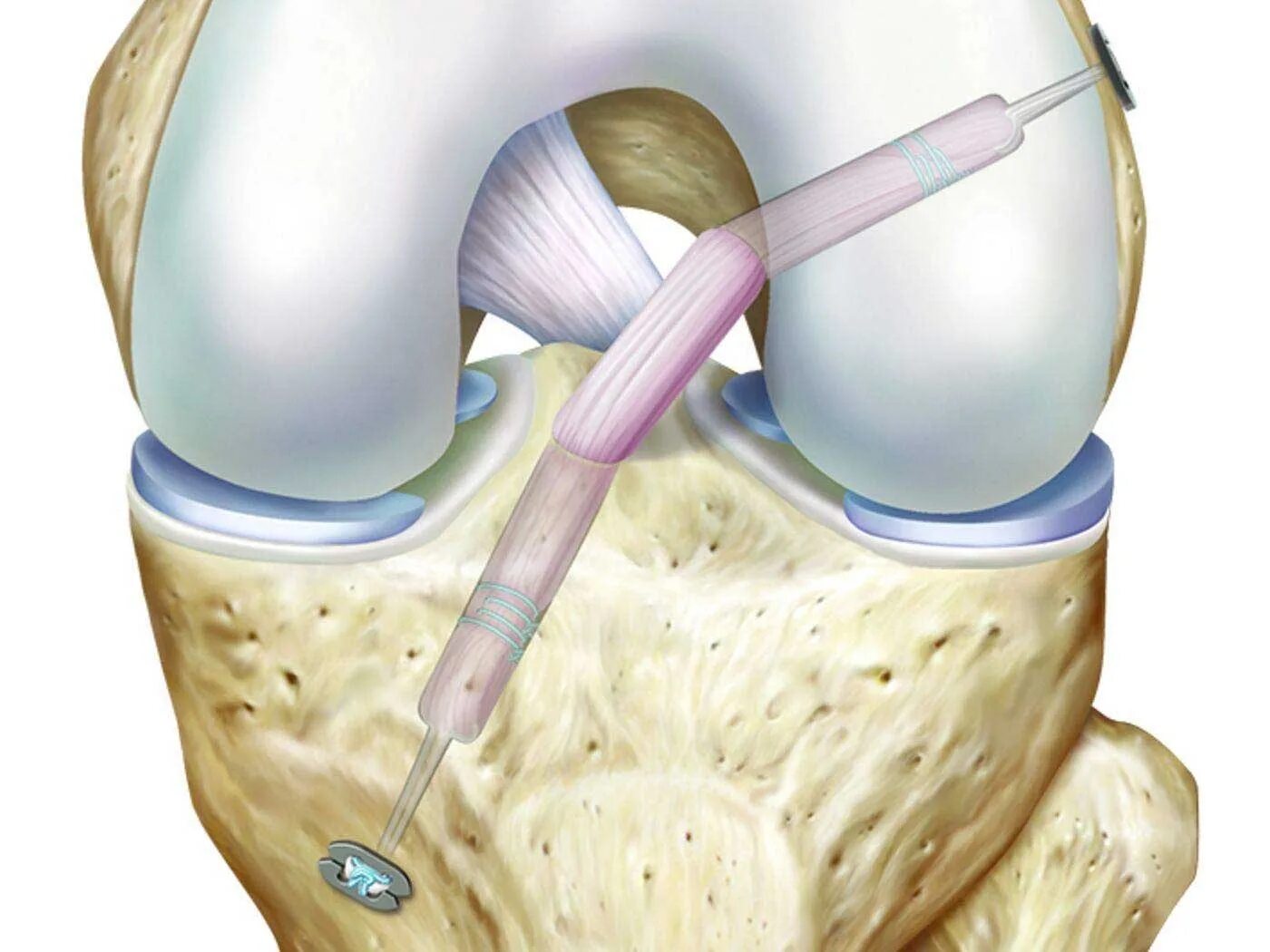 Мениск коленного сустава лечение в домашних. Артропластика ПКС коленного сустава. Разрыв ПКС коленного сустава. Артроскопическая пластика ПКС.
