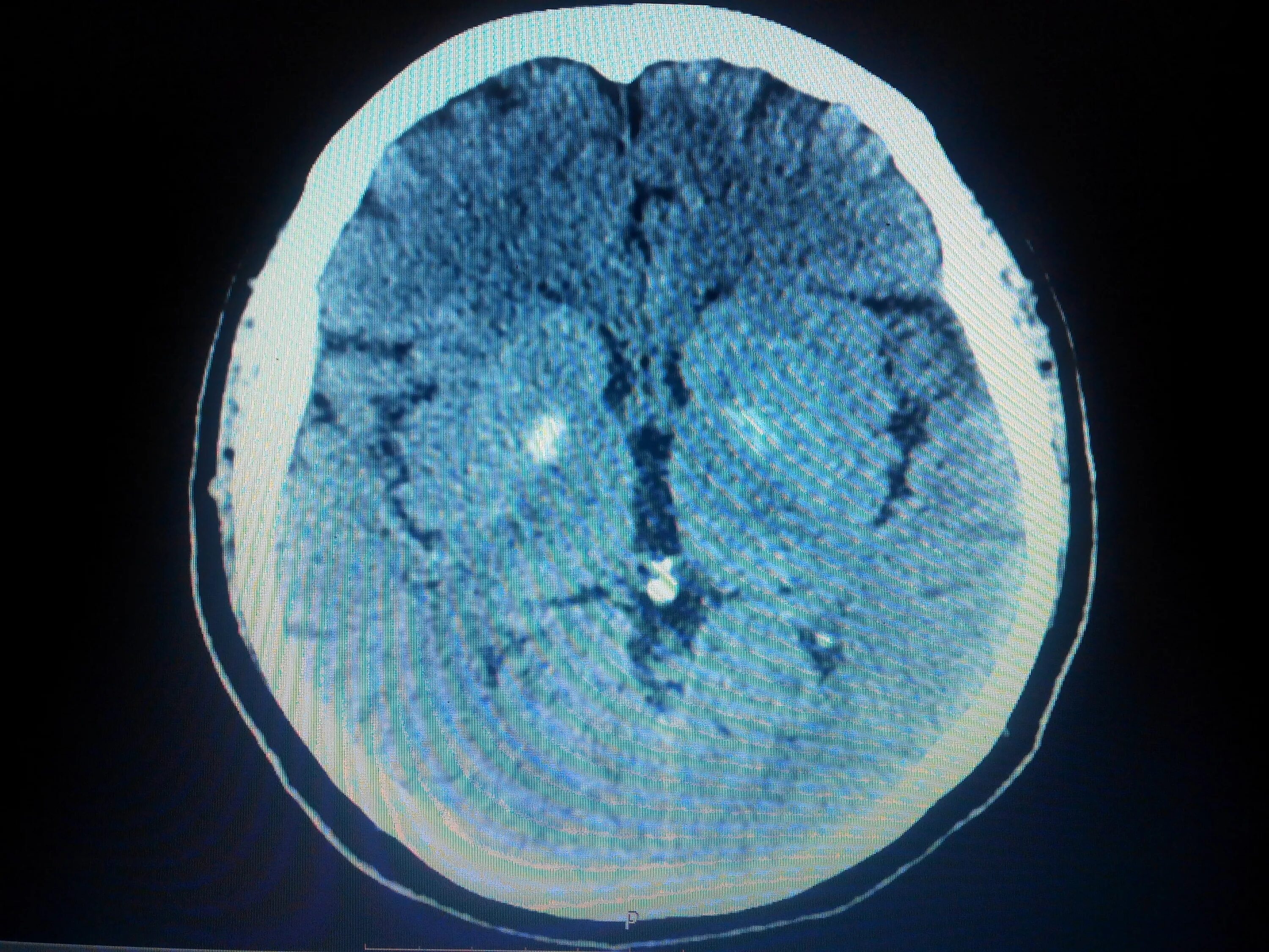 Обызвествления подкорковых ядер на кт. Обызвествление базальных ядер головного мозга на кт. Кровоизлияние в базальные ядра кт. Обызвествление базальных ганглиев кт. Кровоизлияние в желудочки