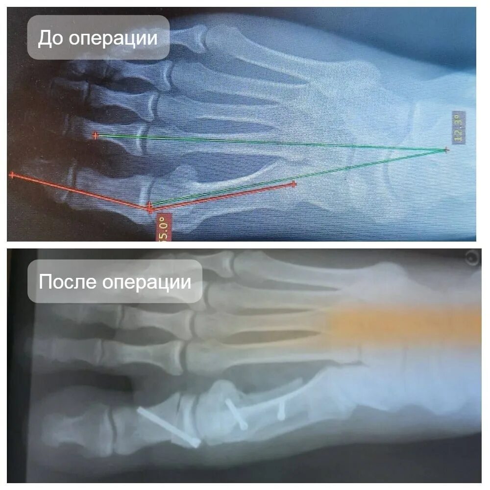 Операция на косточки как называется. Операция по исправлению вальгуса.