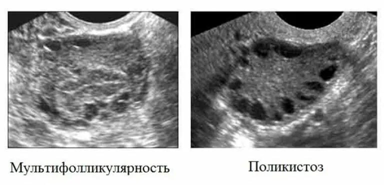 Лечение фолликулов. Синдром поликистозных яичников УЗИ. Мультифолликулярные яичники на УЗИ. УЗИ мультифолликулярных яичников и СПКЯ.