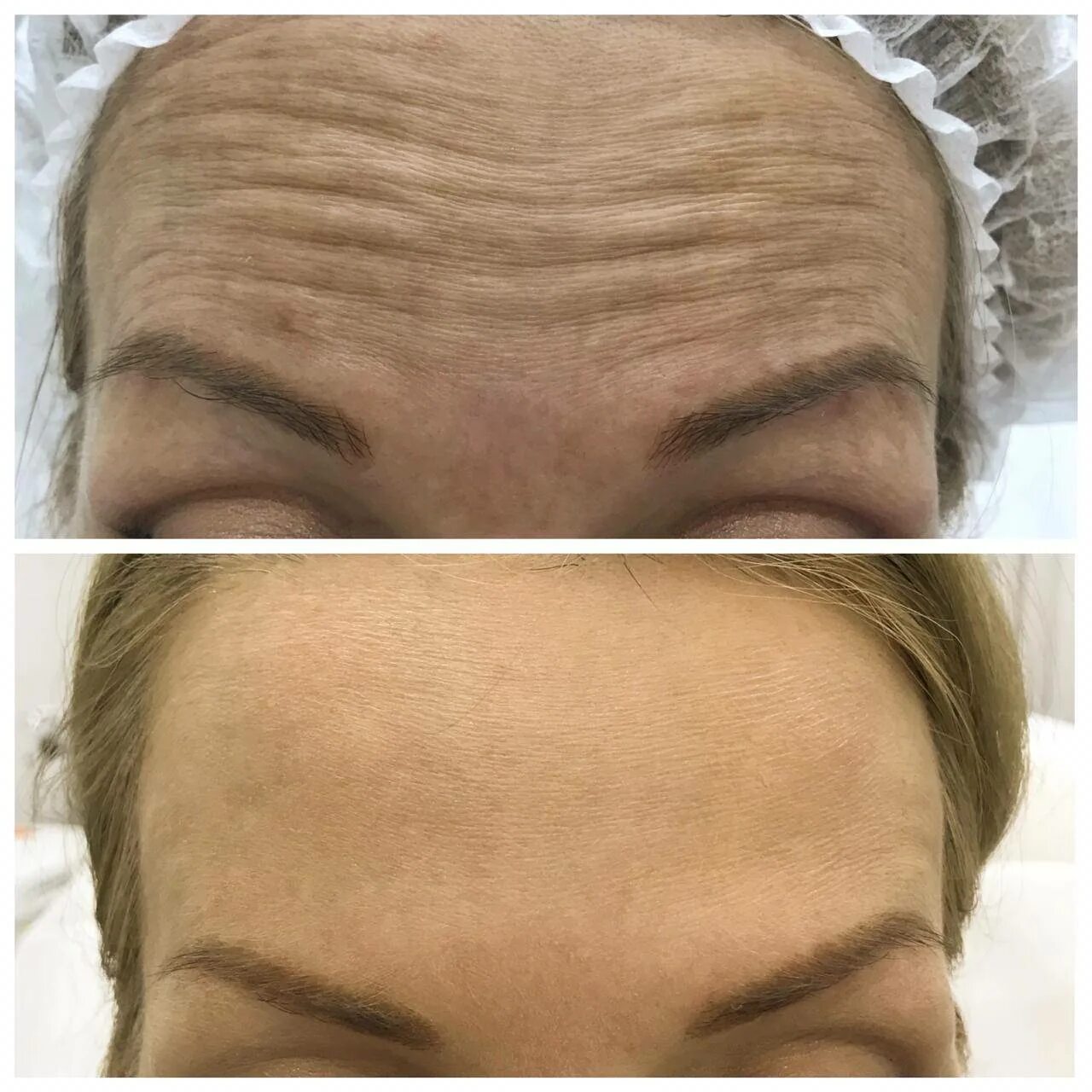 Ботокс вокруг глаз. До и после ботокса лица. До и после ботокса лица. Ботекс морщин отзывы фото. Уколы от морщин до и после.