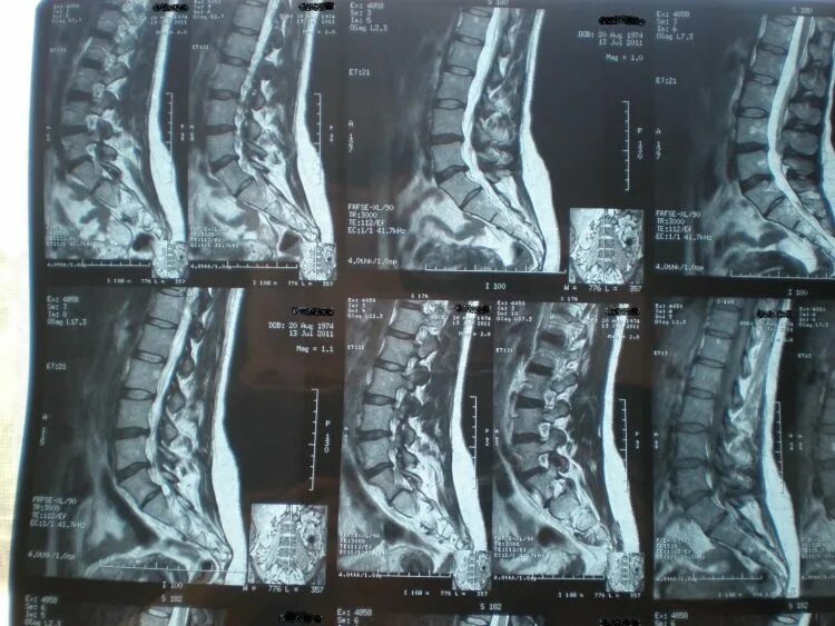 Остеохондроз поясничного отдела l5 s1. Снимки мрт s1 s2. Остеохондроз l5-s1 поясничного отдела. Остеохондроз l4-s1. Остеохондроз l5-s1.