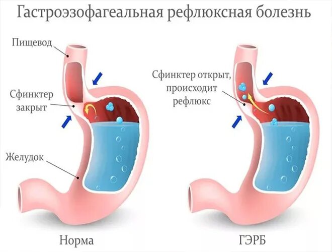 Часто изжога причины у мужчины. Изжога причины. Рефлюксная болезнь сфинктер. Причины возникновения изжоги. ГЭРБ неэрозивная форма.