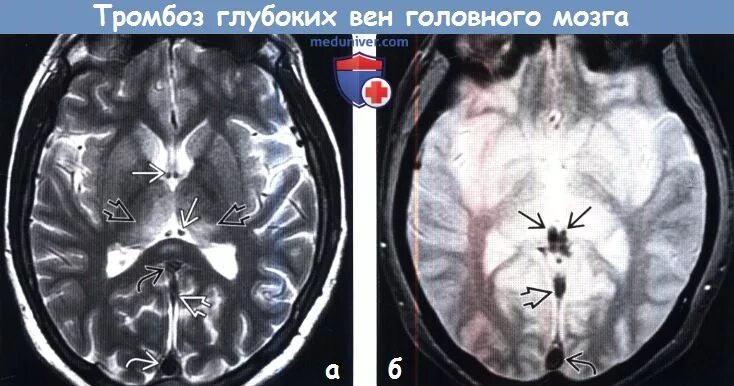 Тромбоз артерии мозга. Тромбоз синусов головного мозга кт. Тромбоз вены Галена кт. Тромбоз кавернозного синуса на кт. Тромбоз сагиттального синуса головного мозга.