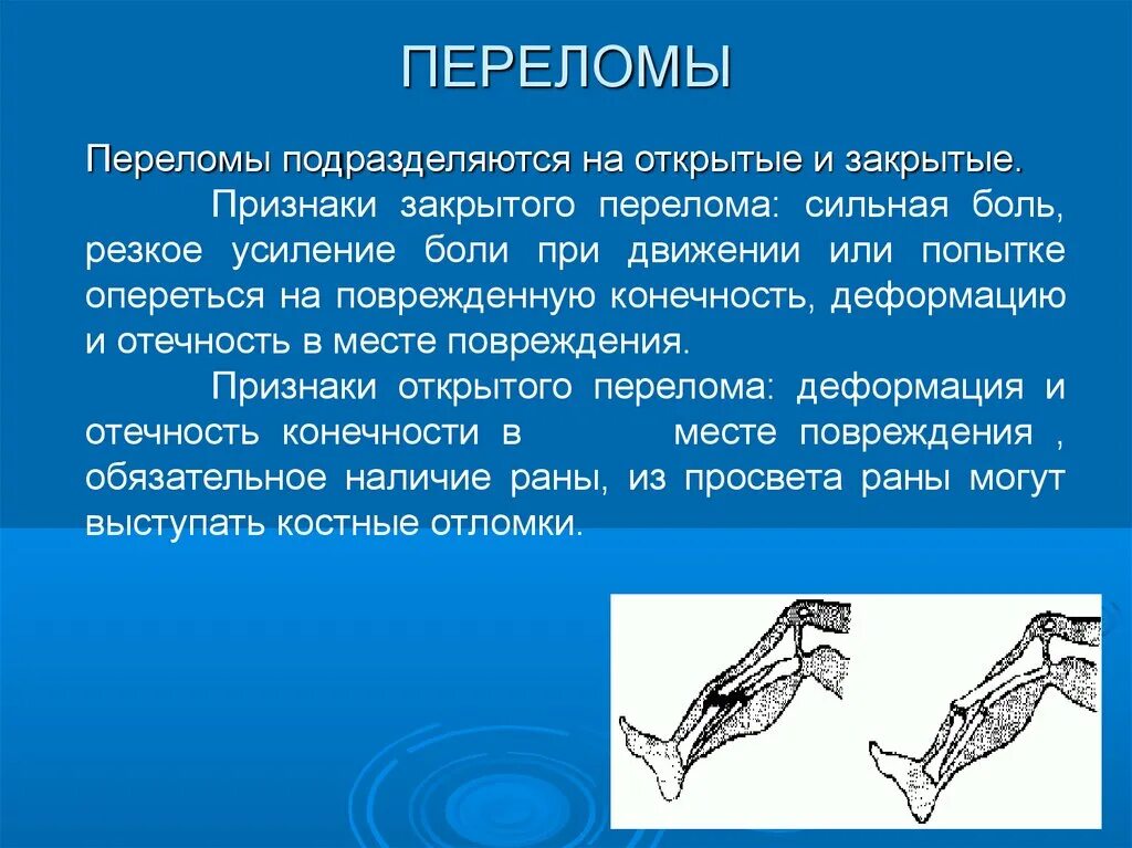 Открытый и закрытый перелом. Переломы подразделяются на. Переломы подразделяются на: открытые.